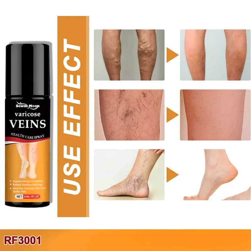 Turmeric Varicose Veins Relief Spray (BUY 1 GET 1 FREE🔥🔥)