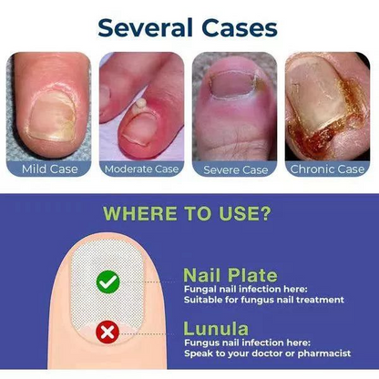 Anti Paronychia Relief Oil 🌿 - (Buy 1 Get 1 FREE🔥🔥)