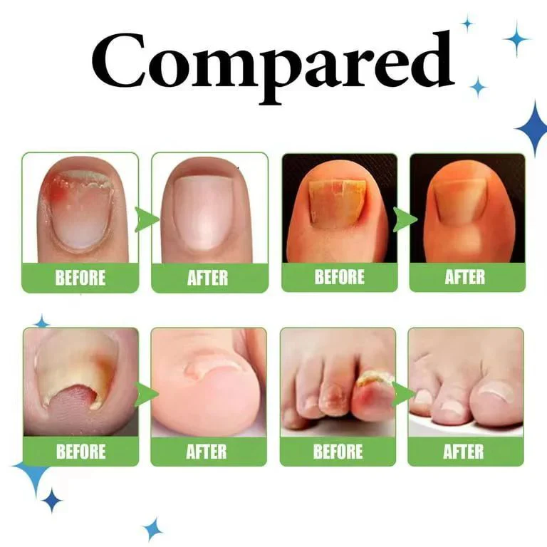 Anti Paronychia Relief Oil 🌿 - (Buy 1 Get 1 FREE🔥🔥)