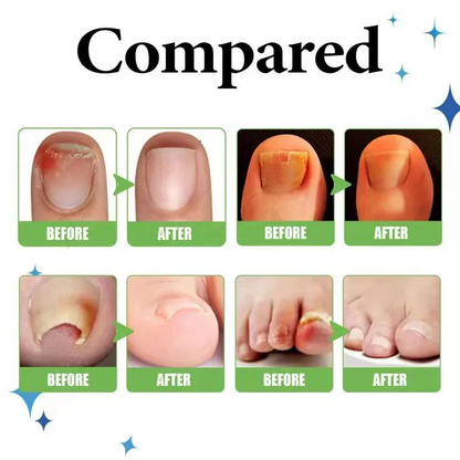 Anti Paronychia Relief Oil 🌿 - (Buy 1 Get 1 FREE🔥🔥)