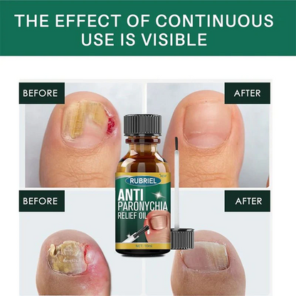 Anti Paronychia Relief Oil 🌿 - (Buy 1 Get 1 FREE🔥🔥)